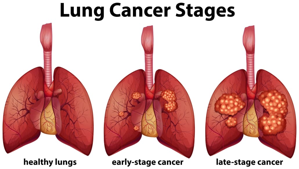 Lung Cancer Awareness